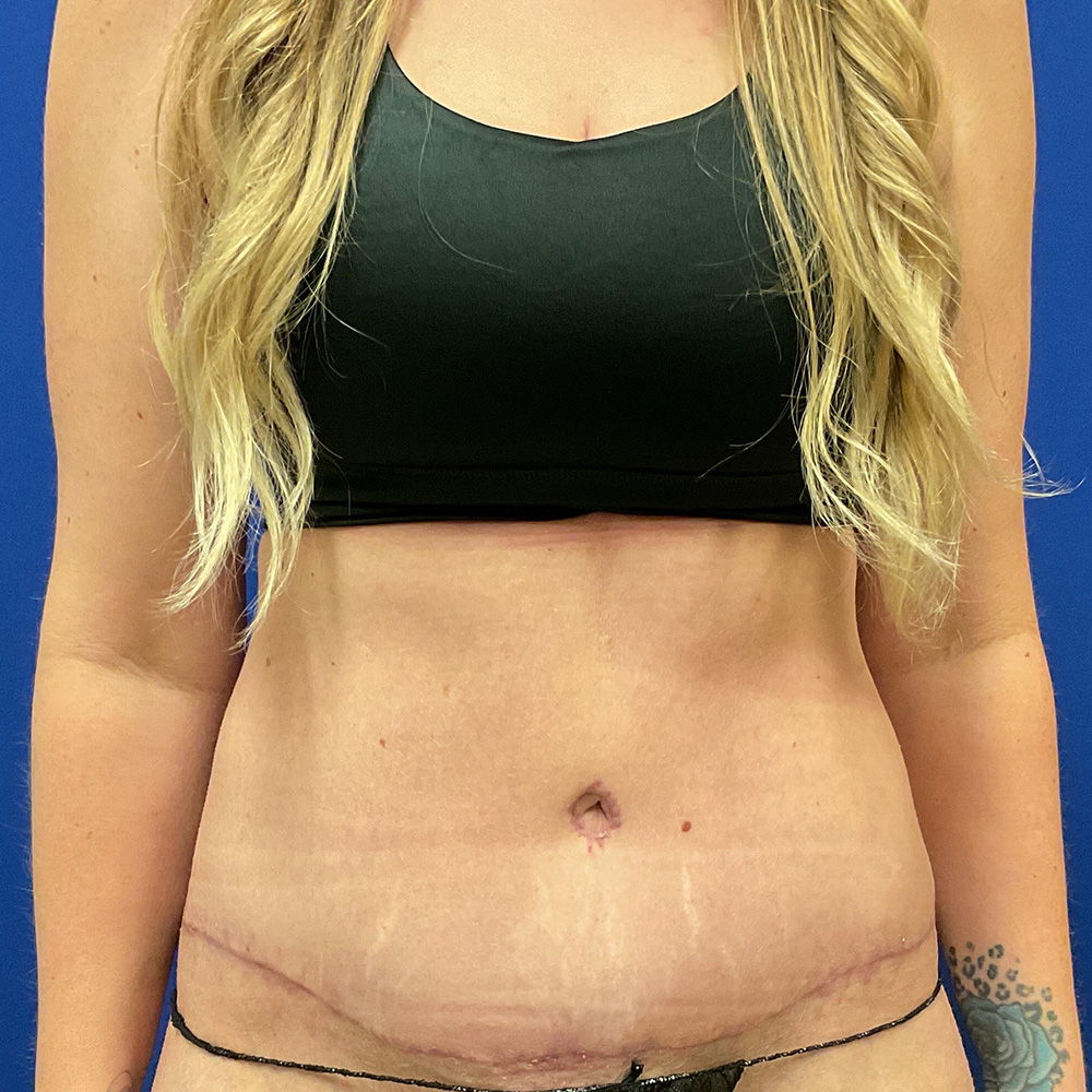 Tummy Tuck with dr raj iyengar - after