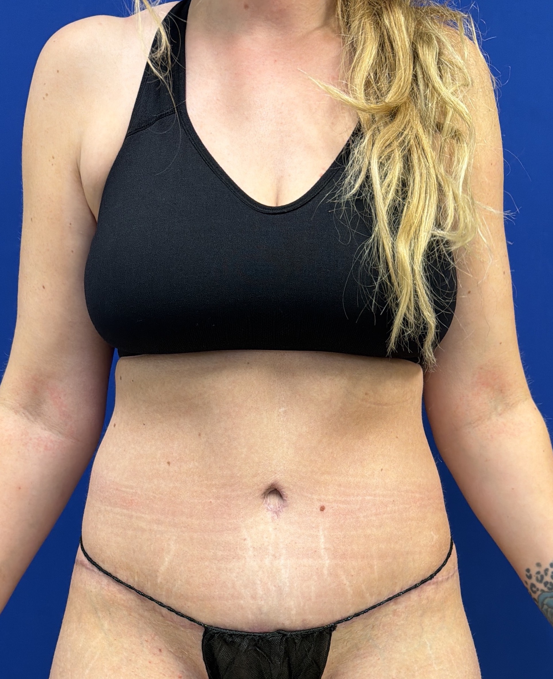 Tummy Tuck with dr raj iyengar - after