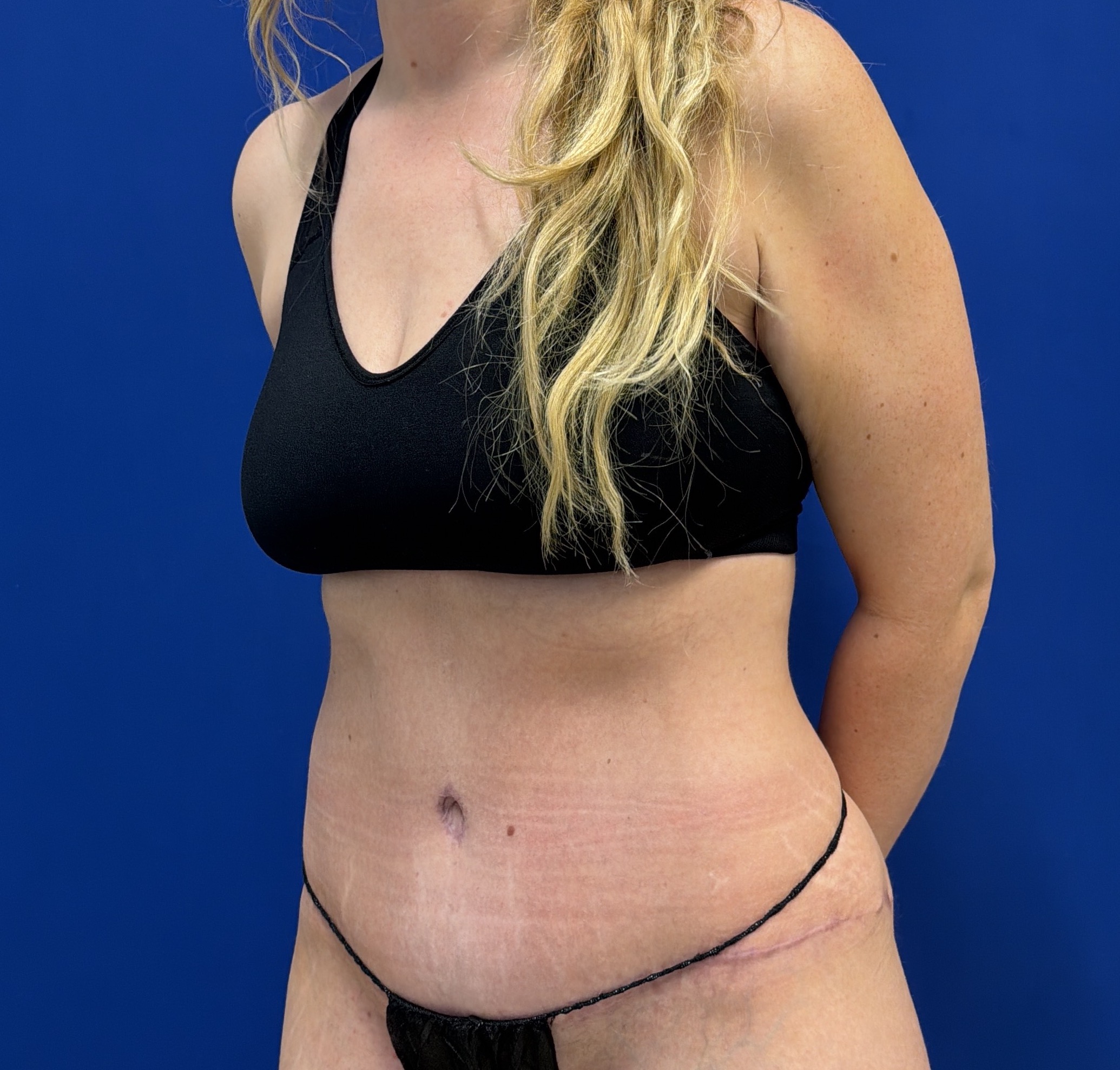 Tummy Tuck with dr raj iyengar - after