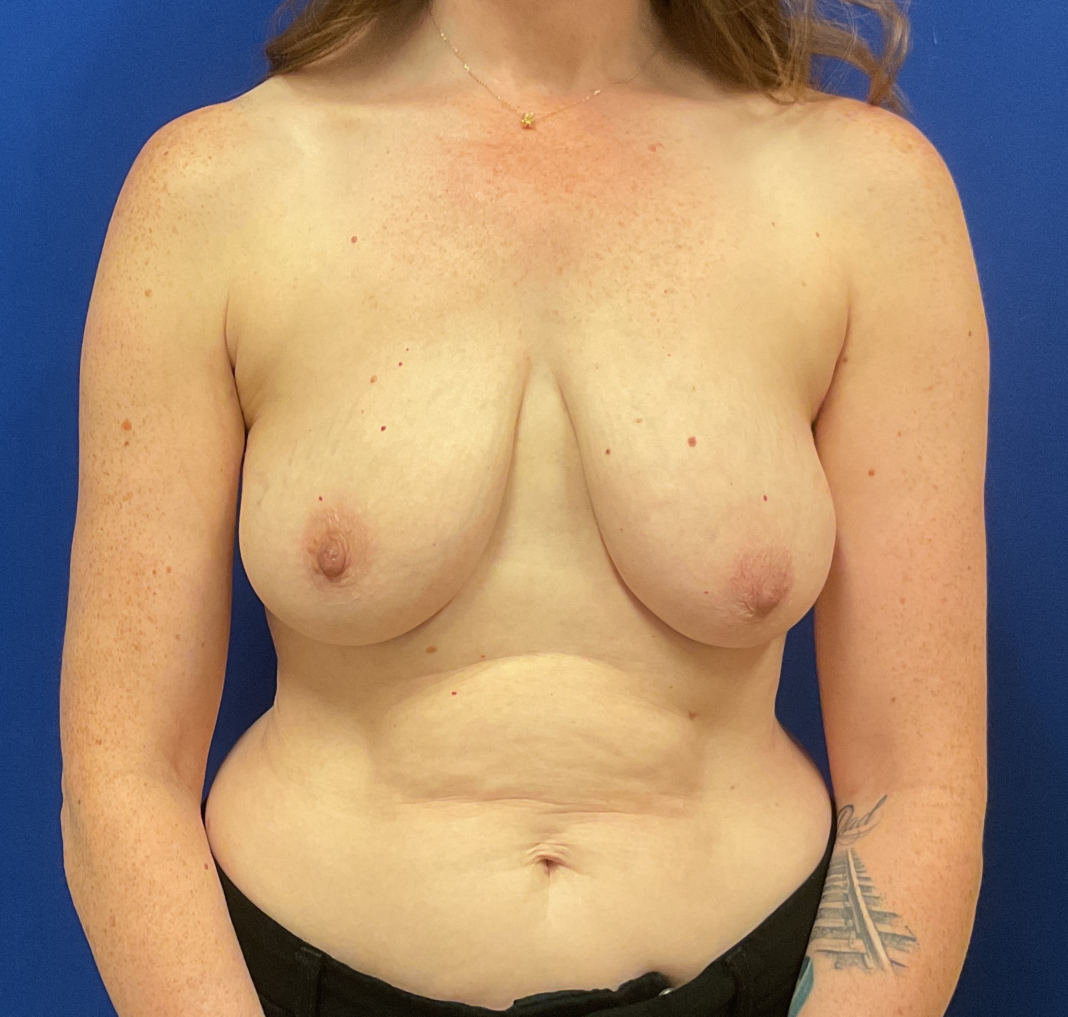 Before mommy makeover procedure with dr. iyengar