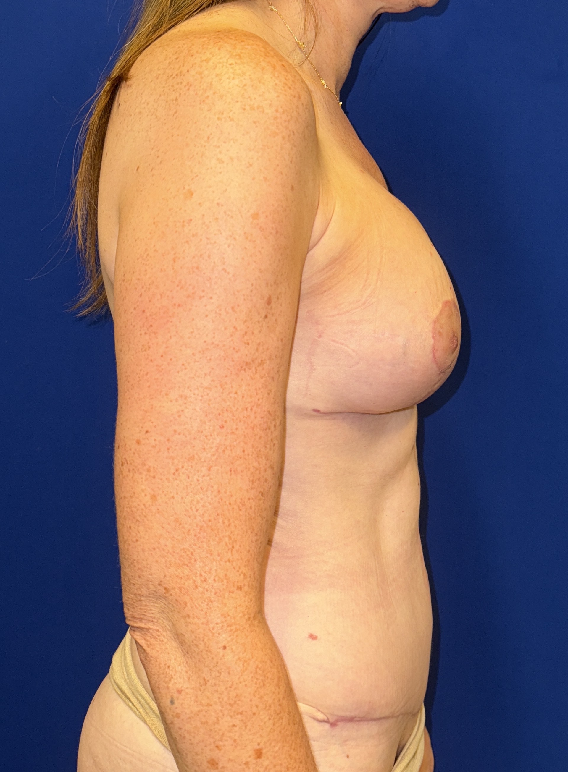 After mommy makeover procedure with dr. iyengar