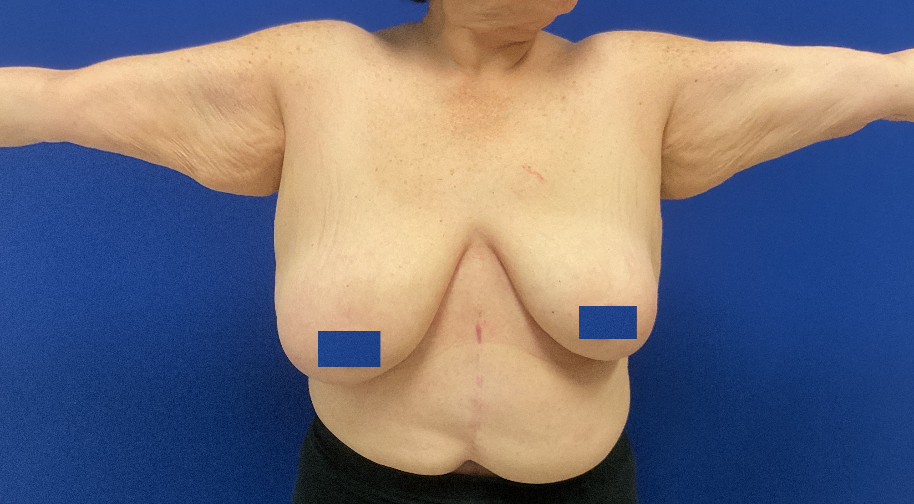 arm lift with dr raj iyengar - before