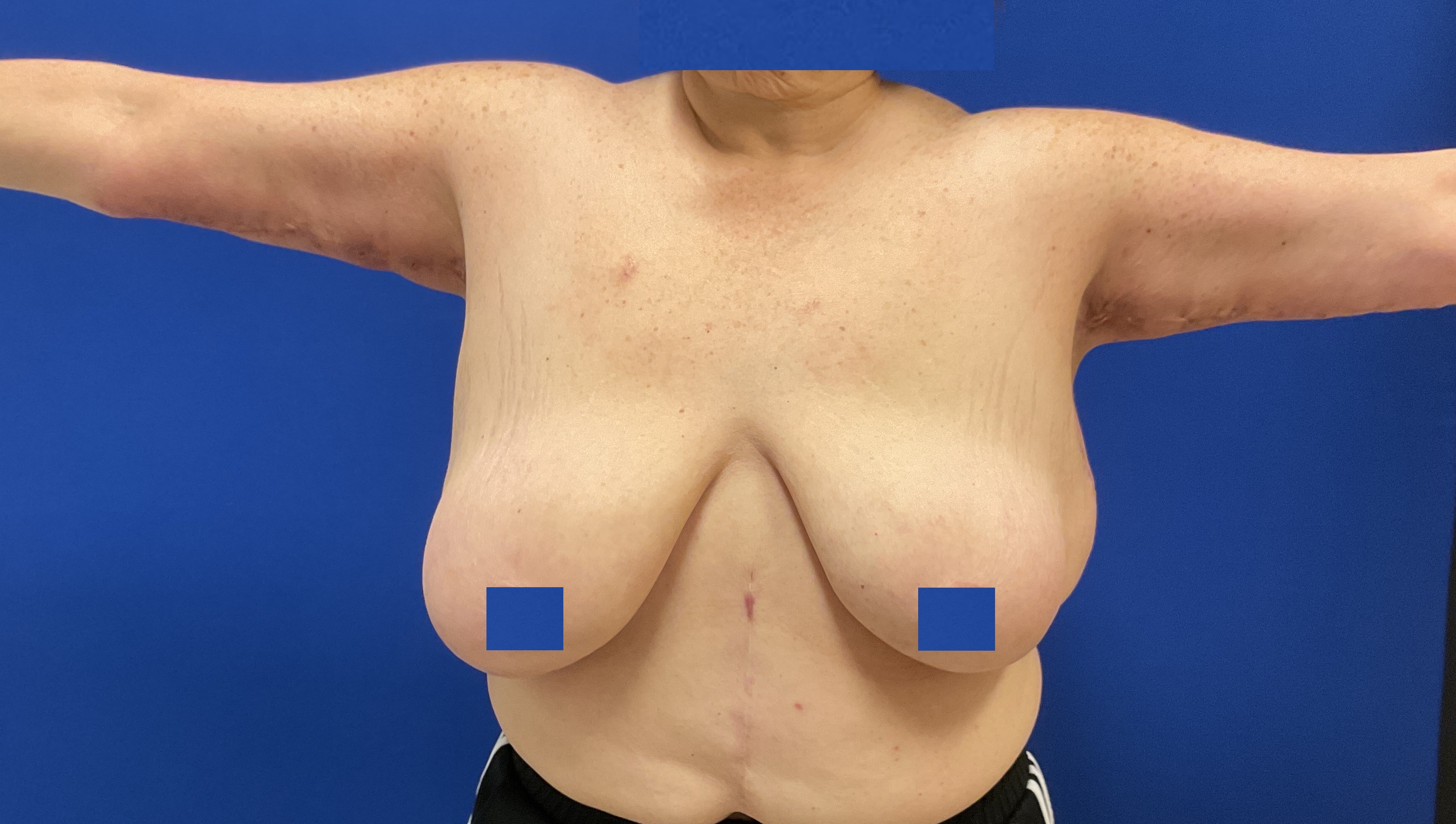 arm lift with dr raj iyengar - after