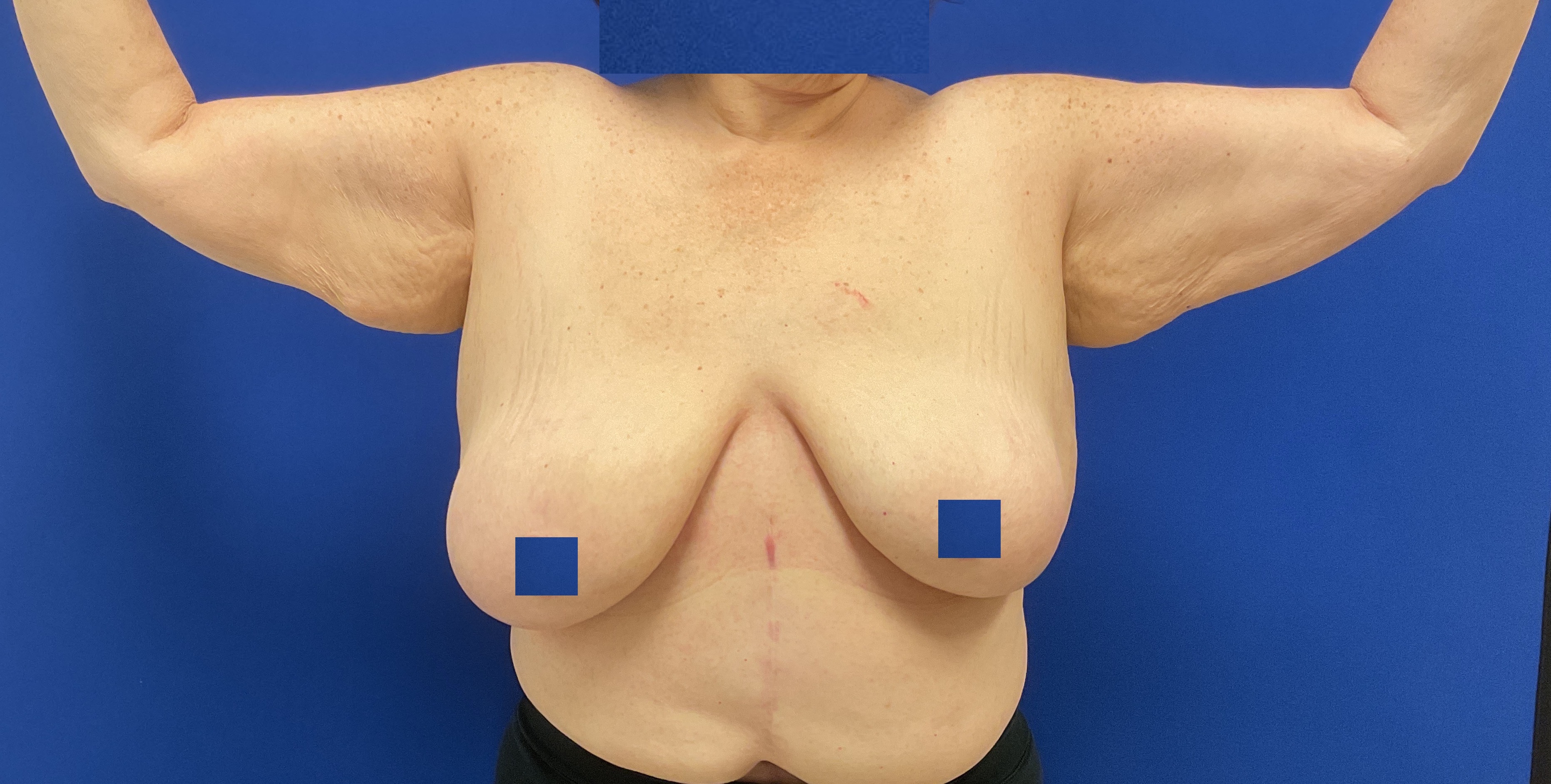 arm lift with dr raj iyengar - before