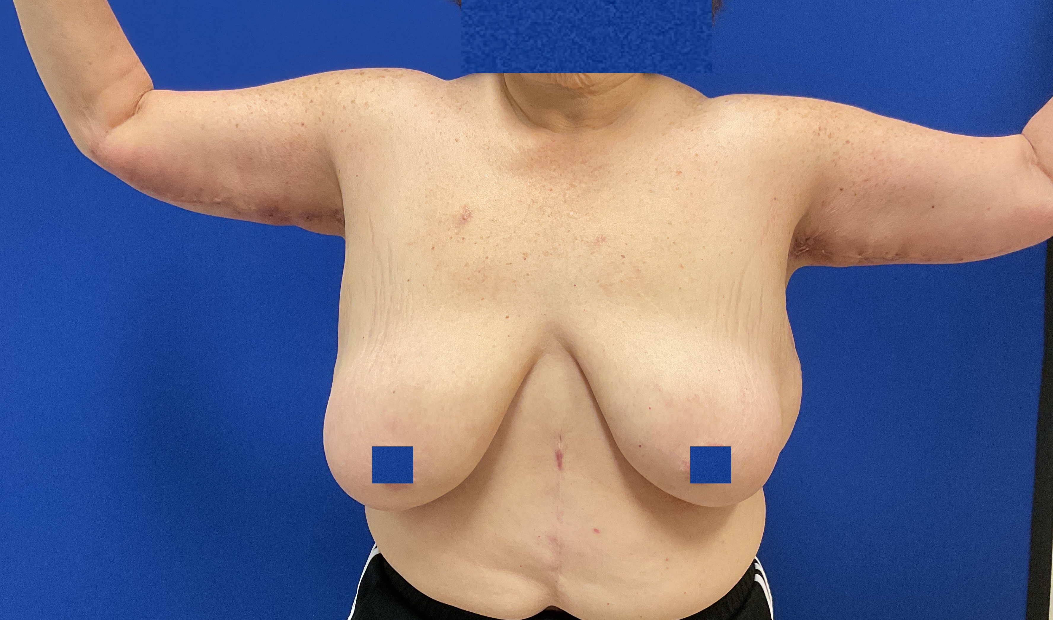 arm lift with dr raj iyengar - after