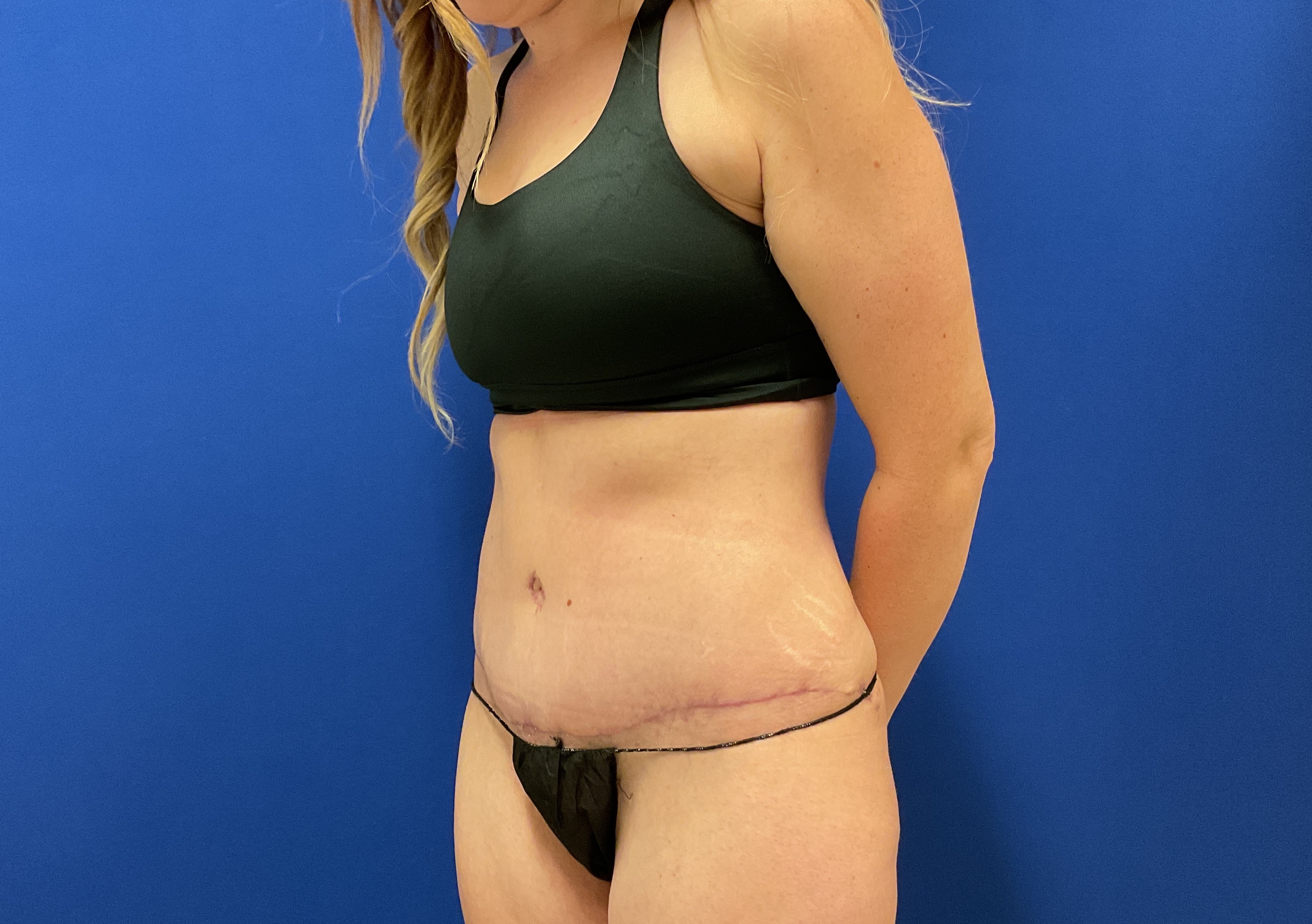 Tummy Tuck with dr raj iyengar - after