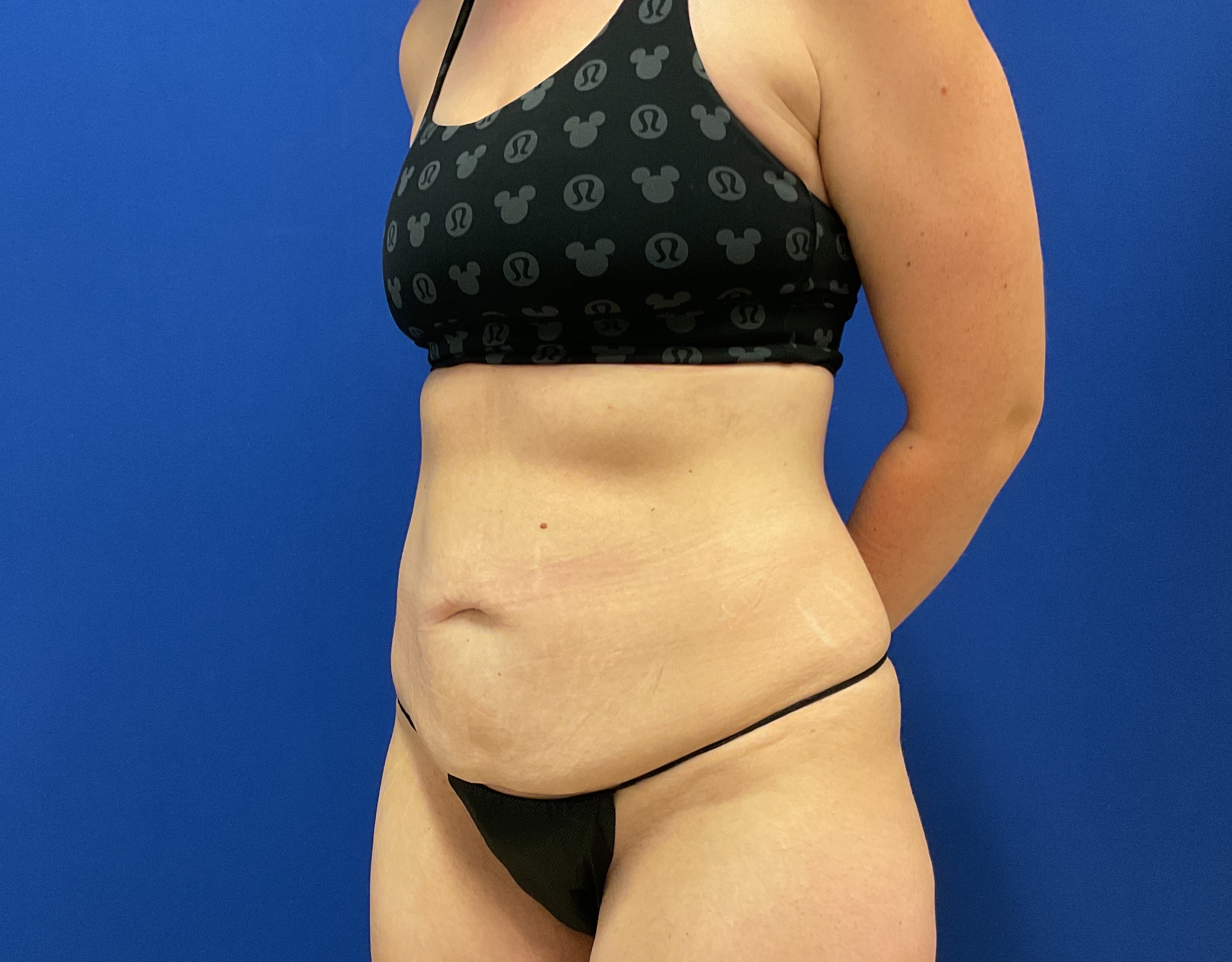 Tummy Tuck with dr raj iyengar - before
