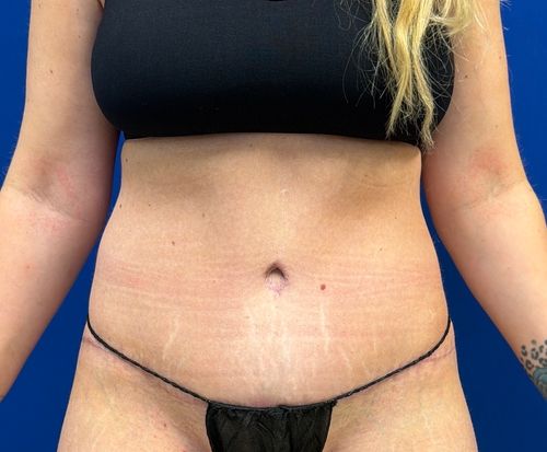Tummy Tuck with dr raj iyengar - after