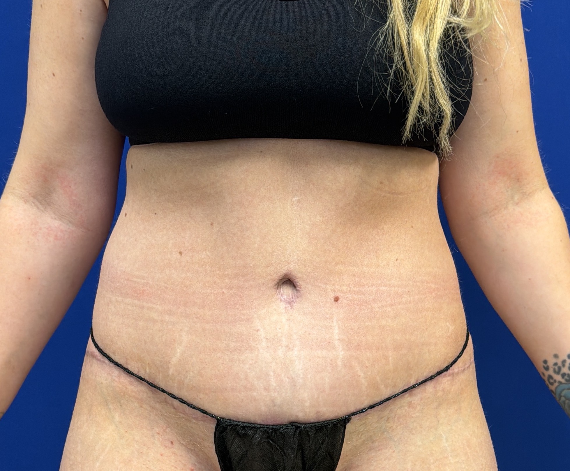 Tummy Tuck with dr raj iyengar - after