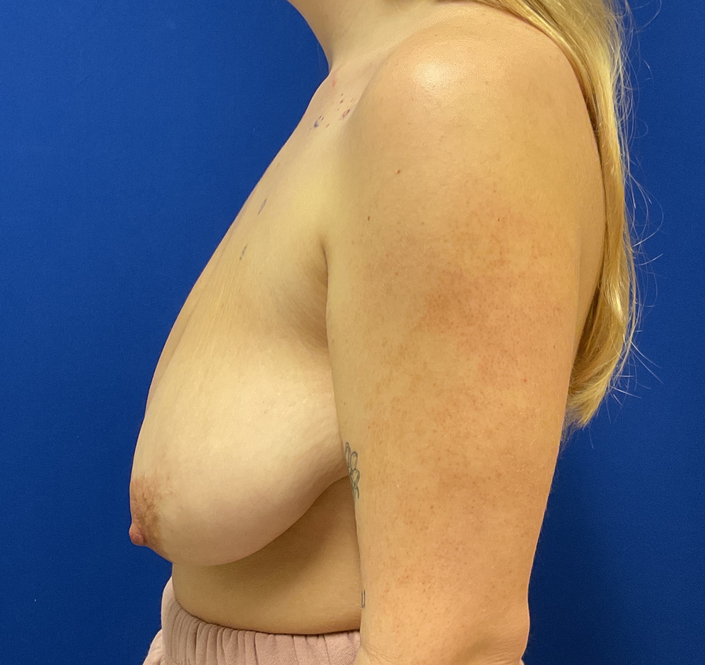 Breast Reduction Before