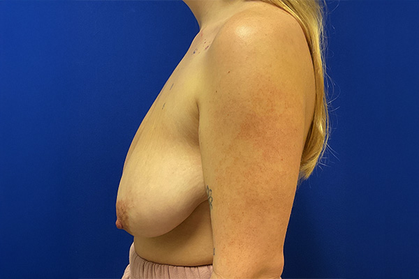 Breast Reduction Before