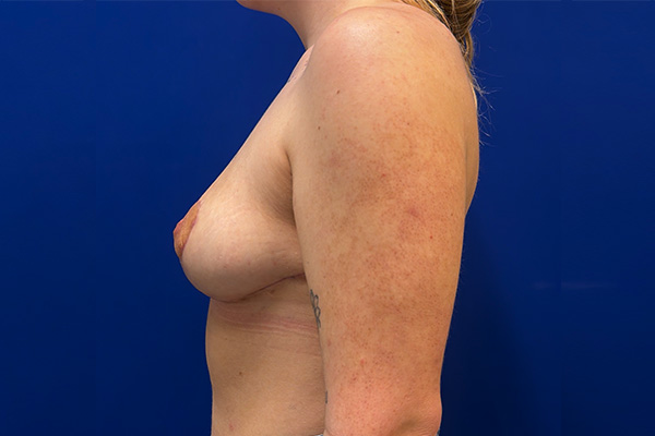 Breast Reduction After