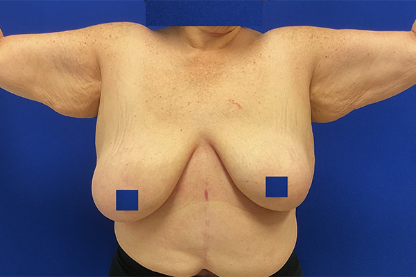 arm lift with dr raj iyengar - before