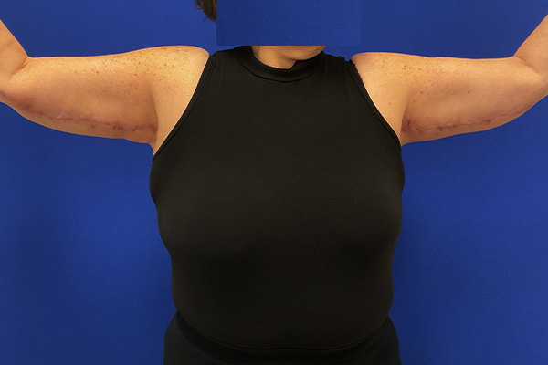 arm lift with dr raj iyengar - after