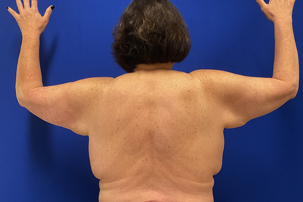 arm lift with dr raj iyengar - before
