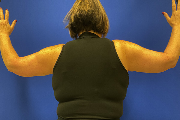 arm lift with dr raj iyengar - after