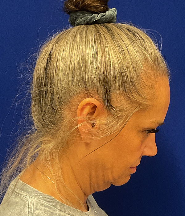 Facelift and necklift before the surgery