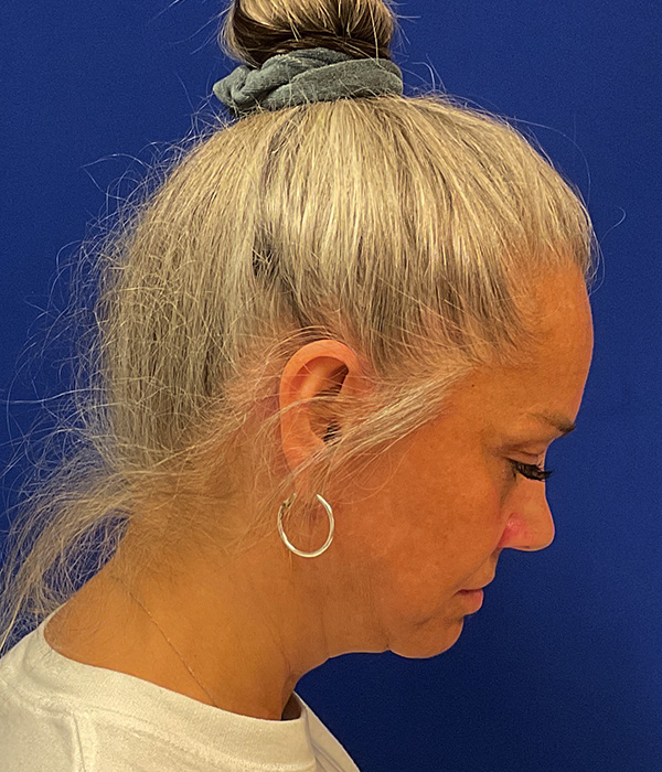 Facelift and necklift after the surgery