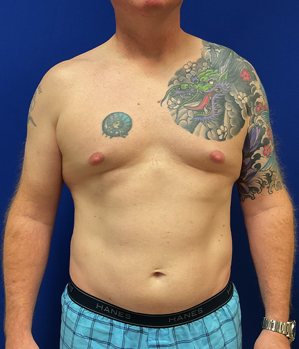 Liposuction with Renuvion with dr raj iyengar - before