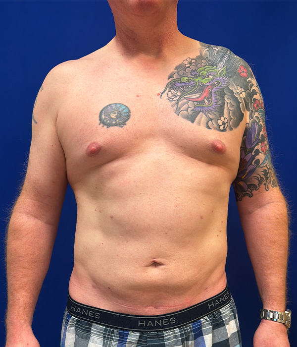 Liposuction with Renuvion with dr raj iyengar - after