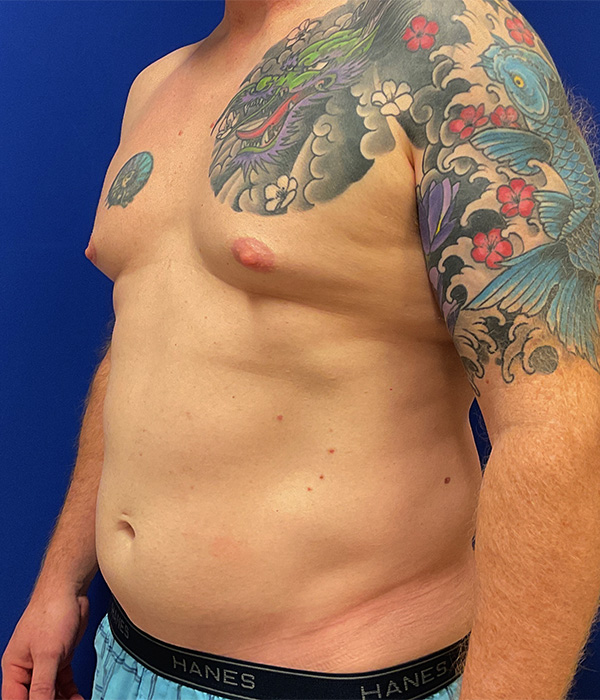 Liposuction with Renuvion with dr raj iyengar - before