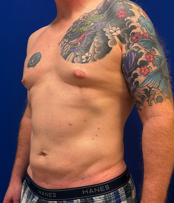 Liposuction with Renuvion with dr raj iyengar - after