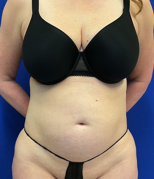lipo-before