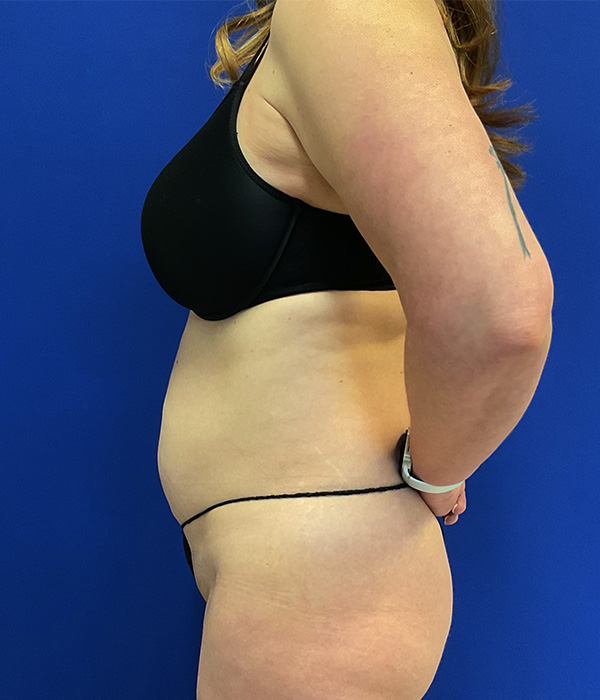 lipo left before 