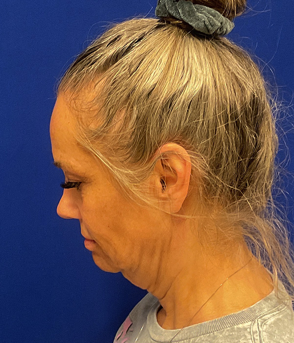 Facelift and necklift before the surgery