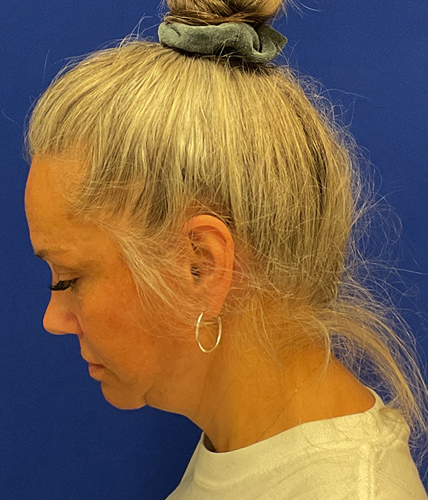 Facelift and necklift after the surgery