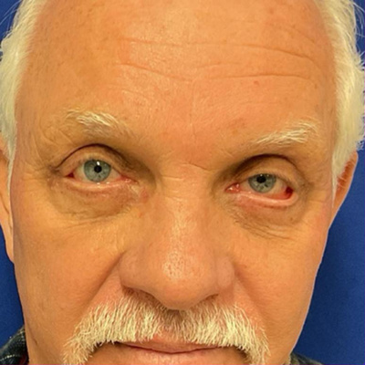 Lower Eyelid Surgery Before