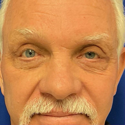 Lower Eyelid Surgery After