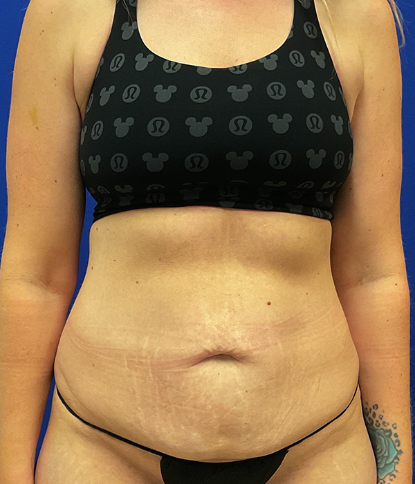 Tummy Tuck with dr raj iyengar - before