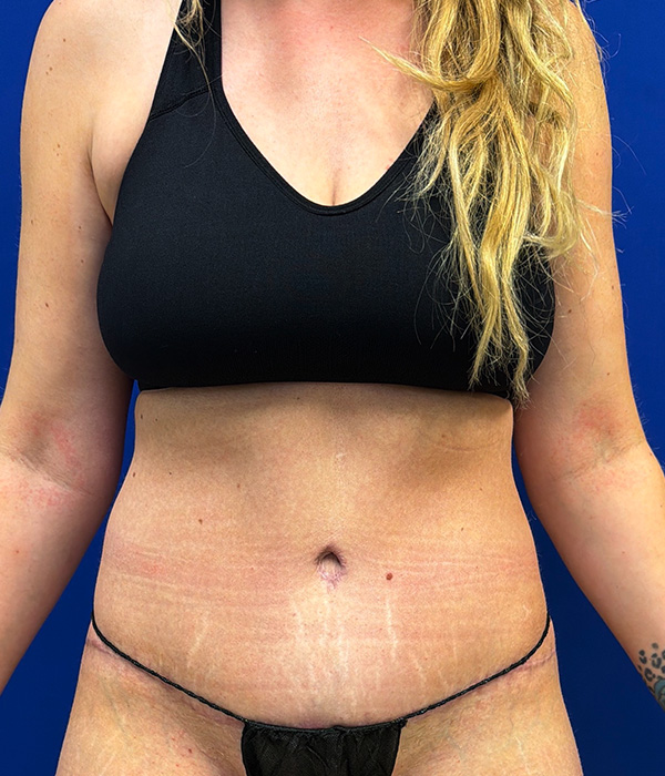 Tummy Tuck with dr raj iyengar - after