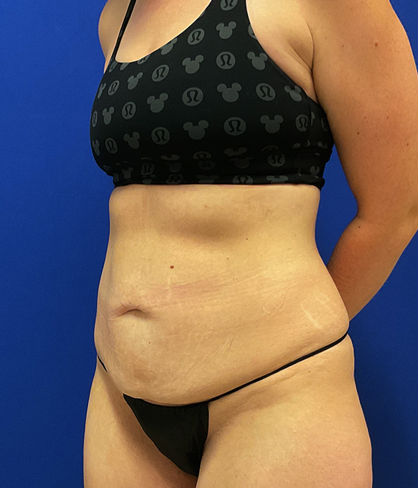 Tummy Tuck with dr raj iyengar - before