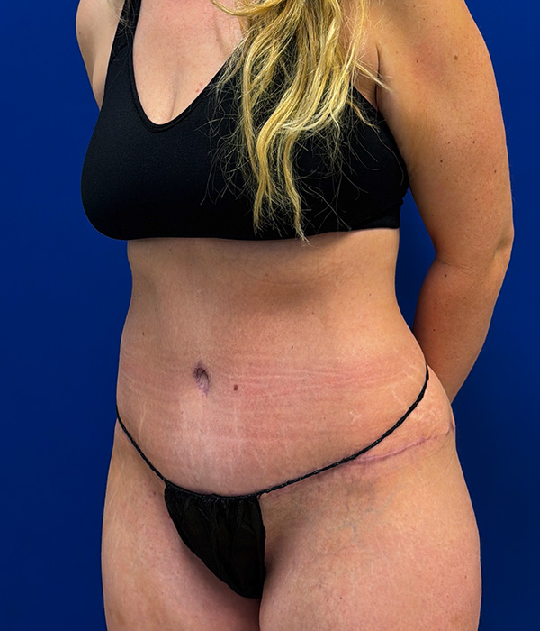 Tummy Tuck with dr raj iyengar - after