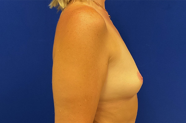 before breast augmentation procedure with dr raj iyengar
