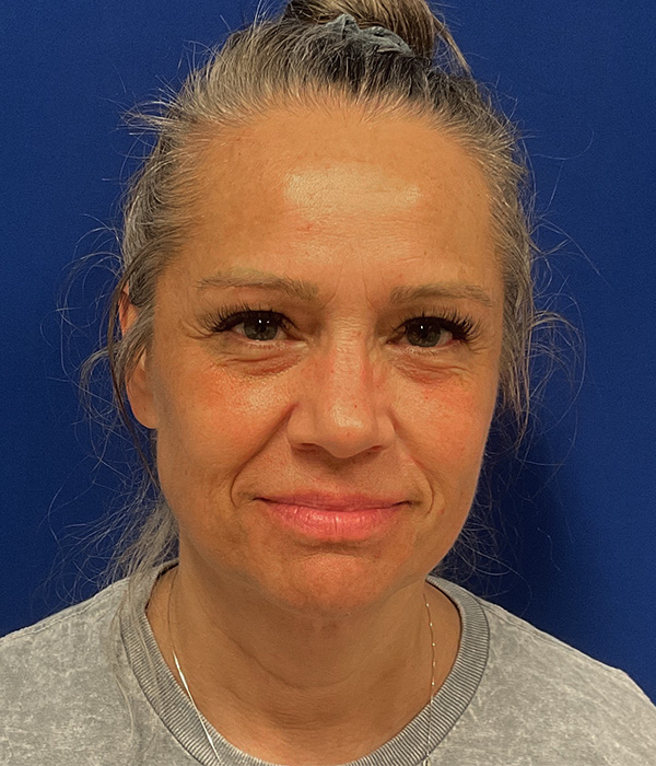 Facelift, SMAS plication and neck lift before photo, front view