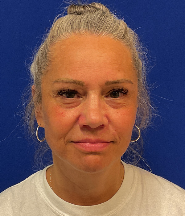 Facelift, SMAS plication and neck lift 11 month after photo, front view