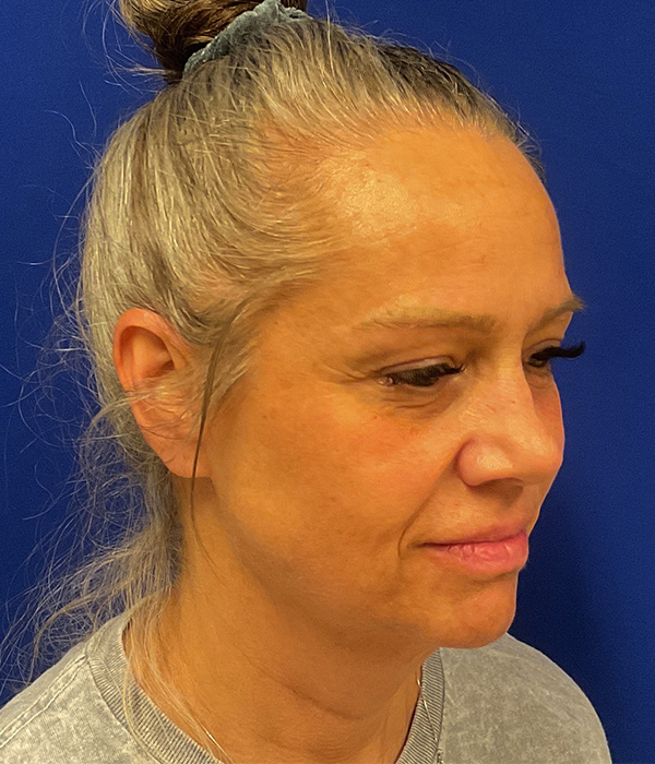 Facelift, SMAS plication and neck lift before photo, right oblique view