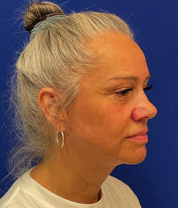 Facelift, SMAS plication and neck lift 11 month after photo, right oblique view