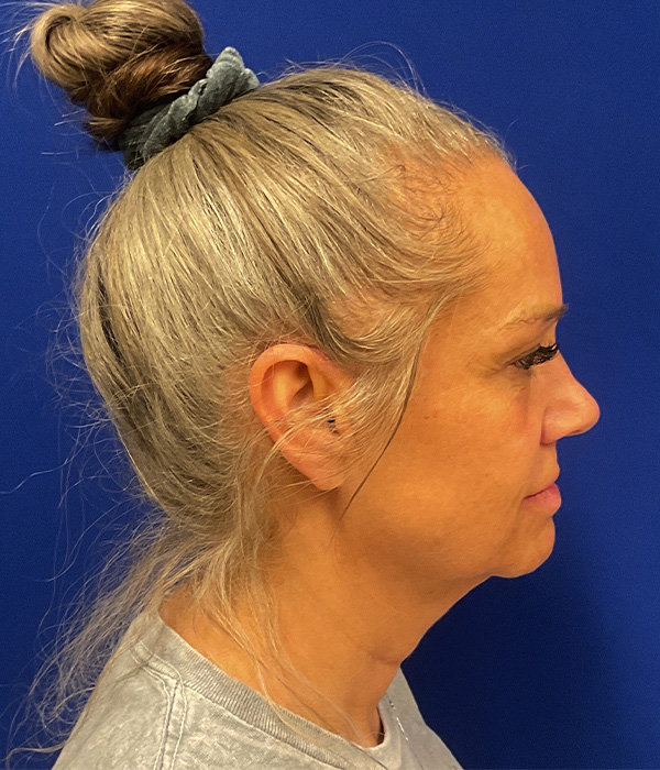 Facelift, SMAS plication and neck lift before photo, right side view