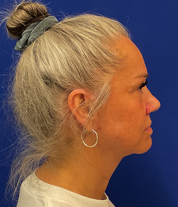 Facelift, SMAS plication and neck lift 11 month after photo, right side view