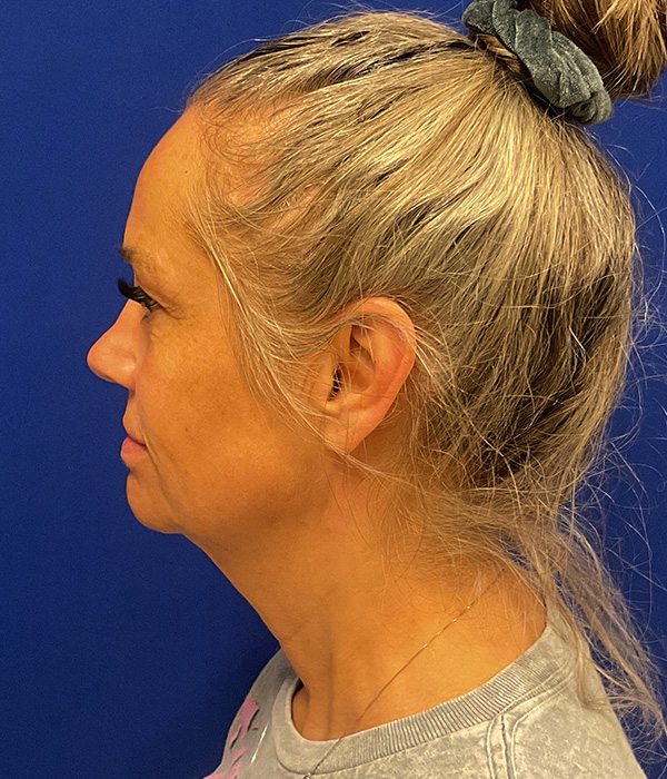 Facelift, SMAS plication and neck lift before photo, left side view