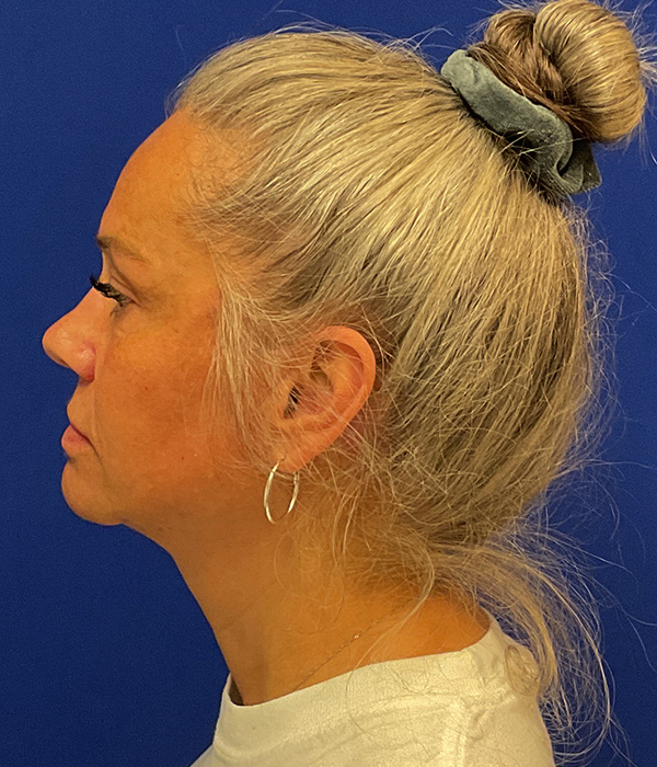 Facelift, SMAS plication and neck lift 11 month after photo, left side view