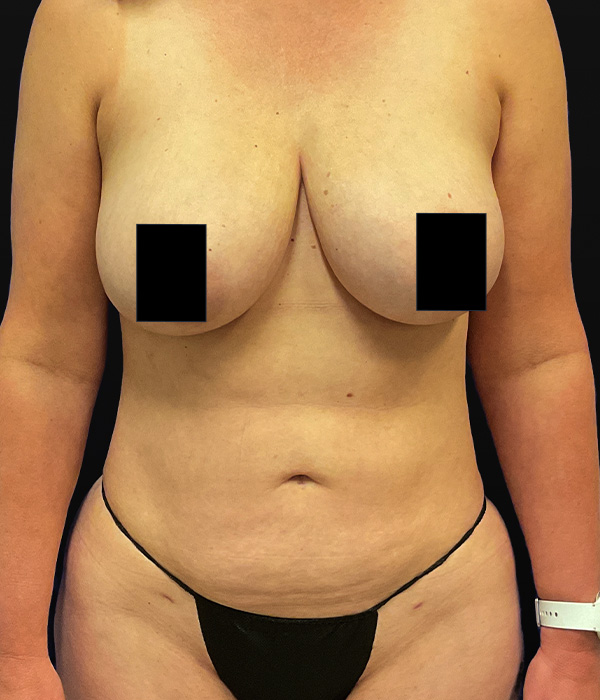 Liposuction and Renuvion to abdomen after photo, front view