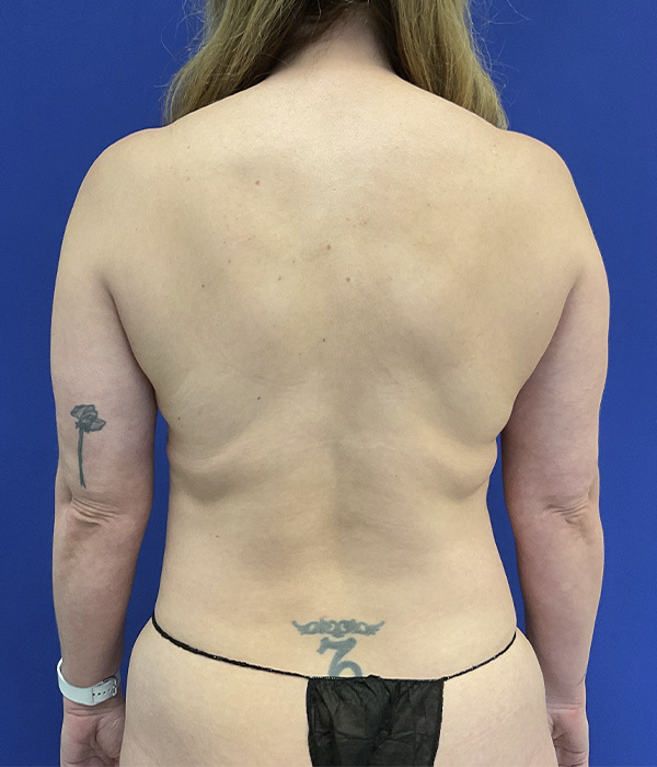 Liposuction and Renuvion before photo, back view