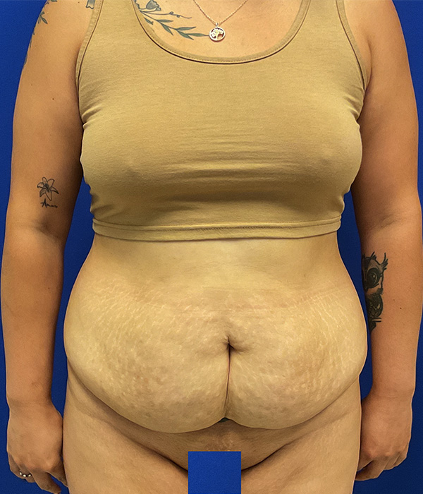 Tummy tuck with 360 liposuction before photo, front view