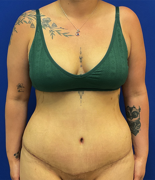 Tummy tuck with 360 liposuction 8 week after photo, front view