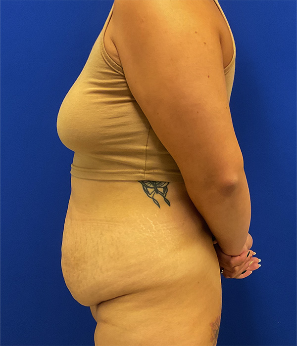 Tummy tuck with 360 liposuction before photo, left side view